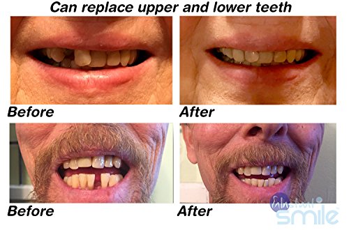Instant Smile MULTISHADE Patented Temporary Tooth Repair Kit. A Realistic Looking Fix for a Missing or Broken Tooth.